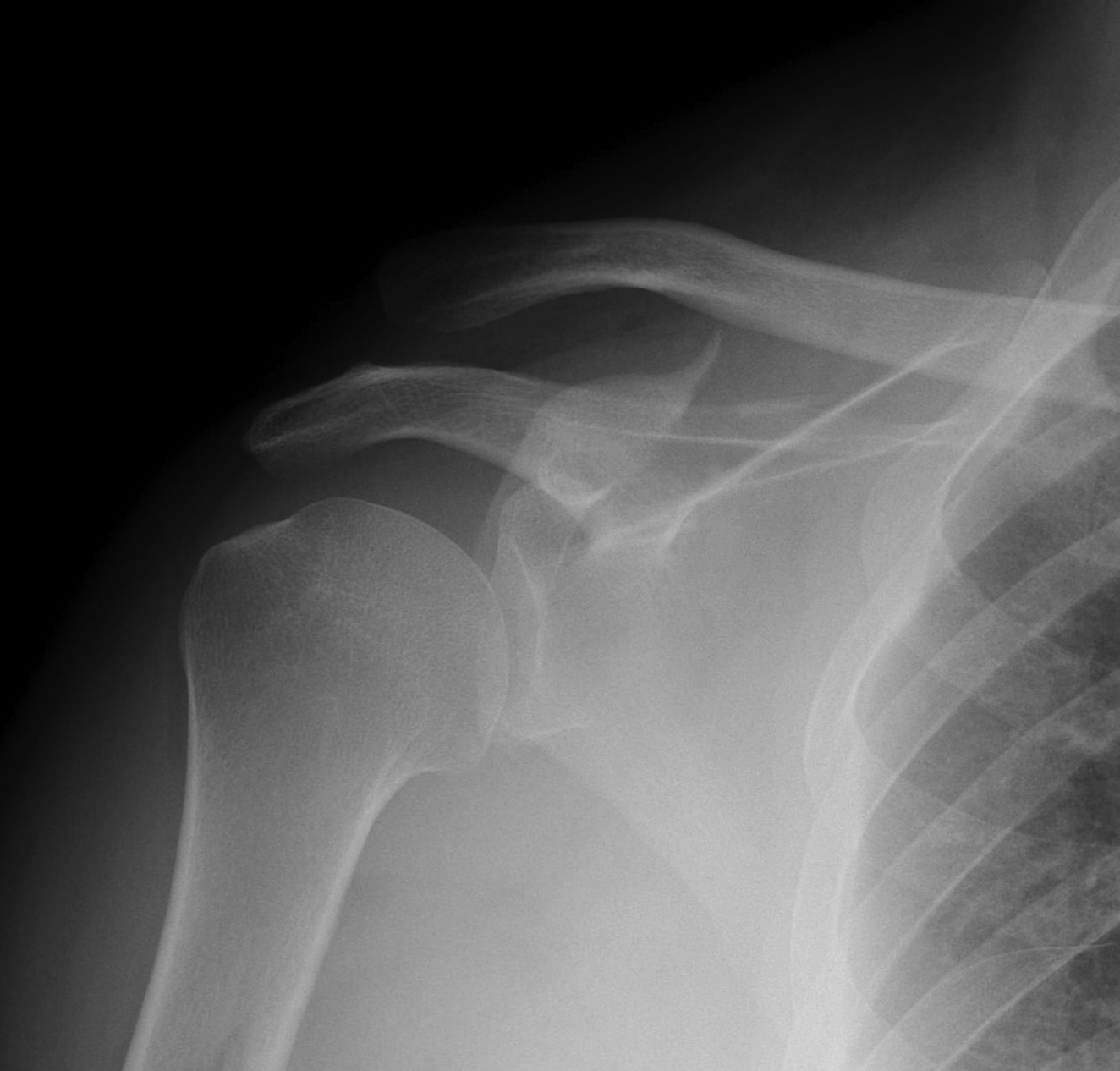 Coracoid Fracture 1